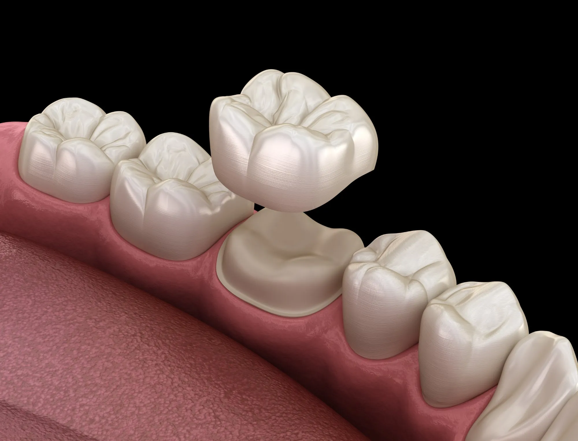 Same Day Crowns — our approach